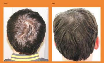 Hair restoration procedure before and after pictures