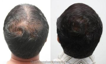 Back view before and after hair transplantation photos