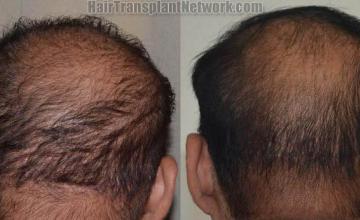 Hair transplantation surgery before and after pictures