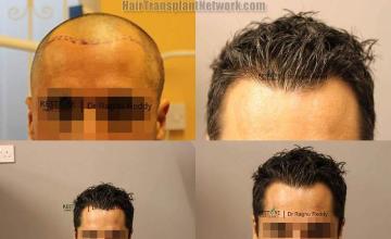 Hair restoration procedure before and after results