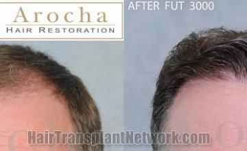 Hair restoration procedure before and after results