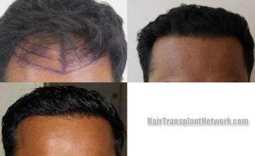 Hair transplantation surgery before and after photos