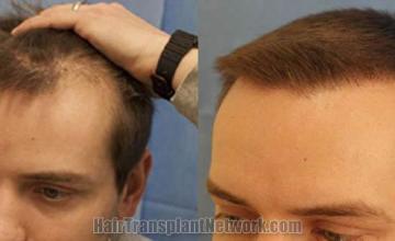 Hair transplantation surgery before and after photos