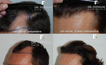 Hair transplantation surgery before and after pictures