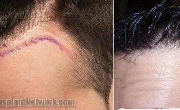 Hair transplantation surgery before and after images