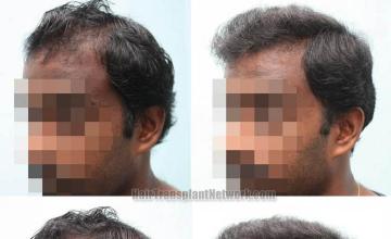 Hair transplantation surgery before and after pictures