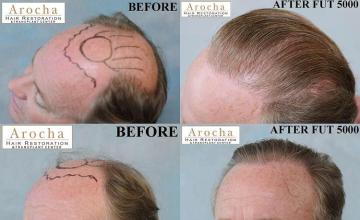 Hair transplantation surgery before and after images