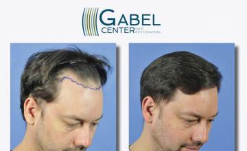 Hair transplantation surgery before and after images