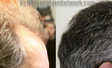 Right view before and after hair replacement surgery