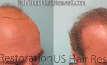 Hair transplantation surgery before and after images