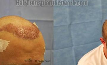 Hair restoration procedure before and after pictures