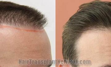 Hair transplantation surgery before and after images