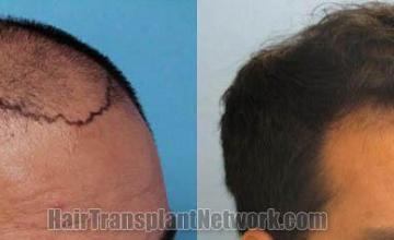 Hair transplantation surgery before and after photos