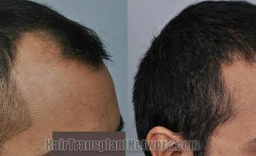 Hair transplantation surgery before and after images