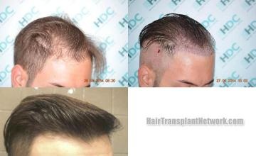 Hair transplantation surgery before and after photos