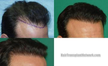 Hair transplantation surgery before and after images