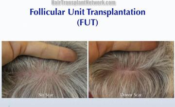 Hair restoration procedure before and after pictures