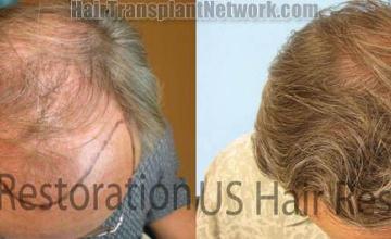 Before and after hair restoration pictures top view