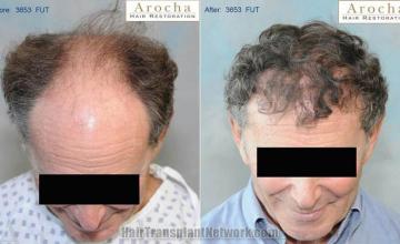 Hair transplantation surgery before and after images