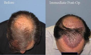 Top view before and after hair restoration results