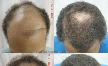 Top view before and after hair restoration results