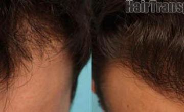 Hair transplantation surgery before and after photos