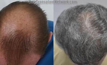 Hair transplantation surgery before and after photos