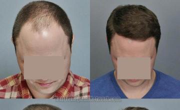 Top view - Before and after surgical hair replacement