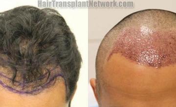 Hair transplantation surgery before and after photos