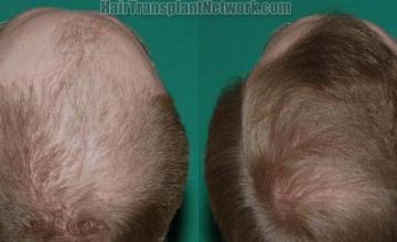 Back view before and after hair transplantation photos