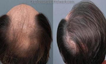 Hair transplantation surgery before and after pictures