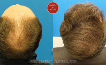 Hair transplantation surgery before and after images