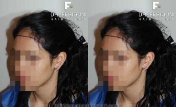 Hair transplantation surgery before and after images