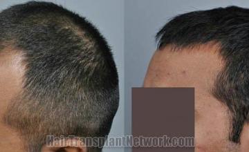 Hair transplantation surgery before and after pictures