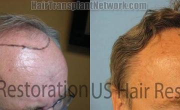 Right view before and after hair restoration procedure