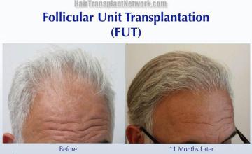 Hair transplantation surgery before and after images