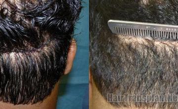 Hair transplant residual donor scar photographs