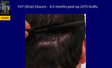 Hair restoration procedure before and after pictures