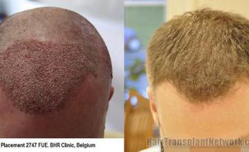 Hair transplantation surgery before and after photos