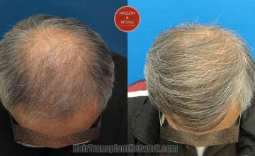 Hair transplantation surgery before and after photos