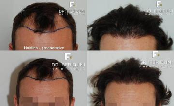 Hair restoration procedure before and after results