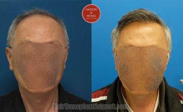 Hair restoration procedure before and after results