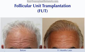 Hair restoration procedure before and after results