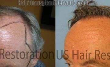 Before and after hair replacement procedure - Left view,