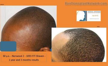 Hair transplantation surgery before and after pictures