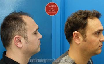 Hair restoration procedure before and after pictures