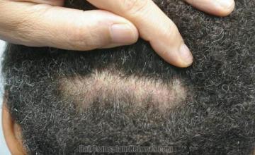 Before and after surgical hair restoration images