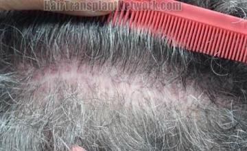 Hair restoration procedure before and after pictures