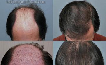 Before and after hair transplant procedure images