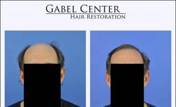 Hair restoration procedure before and after results